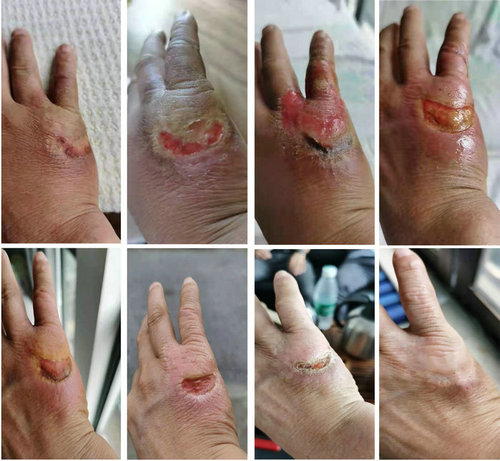 苏州男子神经性皮炎瘙痒难耐 核素治疗解决难顽病灶.jpg