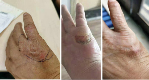 苏州男子神经性皮炎瘙痒难耐 核素治疗解决难顽病灶_0002.jpg