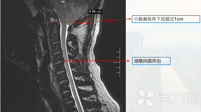 脖子难受以为颈椎病 “元凶”竟是脑疝.png