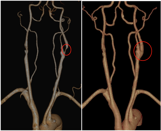 新苏网：男子半年反复头晕 原来是颈动脉重度狭窄.png