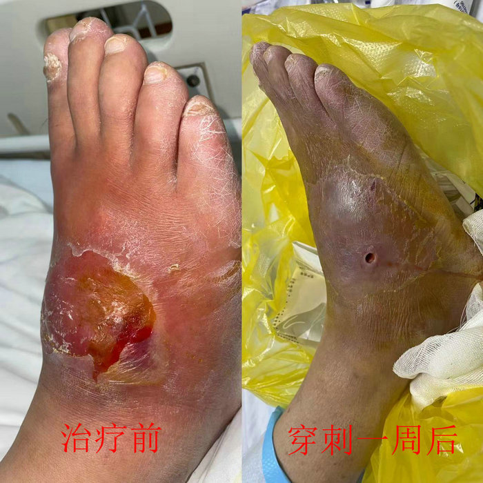 脚肿以为是痛风，专家找出致病“真凶”.jpg