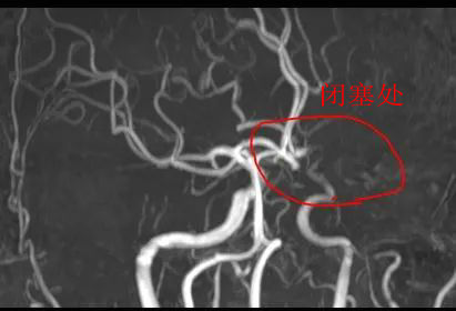 南大苏州医院完成首例Angio-FF脑血流评估.jpg