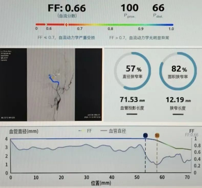 南大苏州医院完成首例Angio-FF脑血流评估2.png