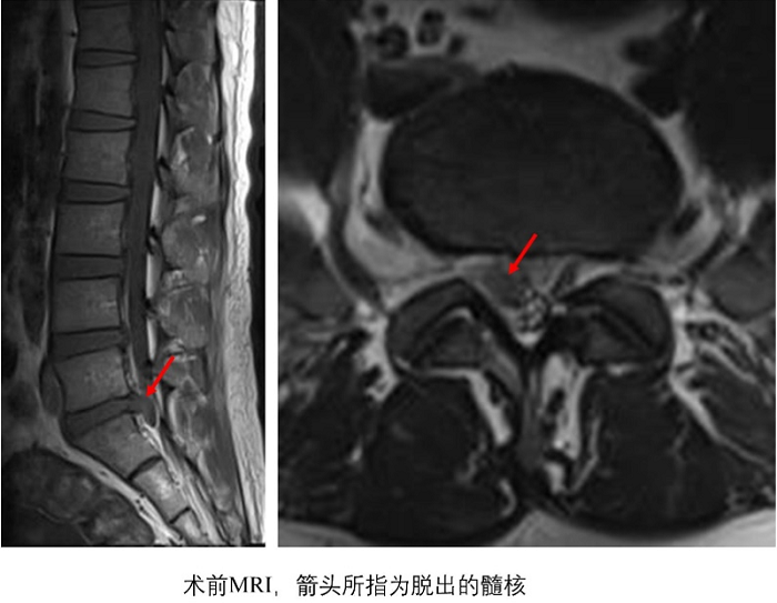 我院成功实施首例ULIF微创术，助力患者腰椎康复.png