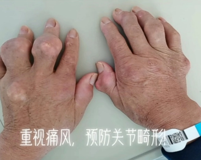 世界痛风日 专家提醒：重视痛风，警惕关节畸形风险.png
