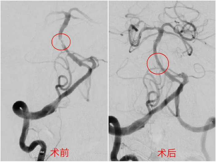 七旬老伯突发脑梗 多学科迅速疏通“生命中枢”成功挽救.jpg