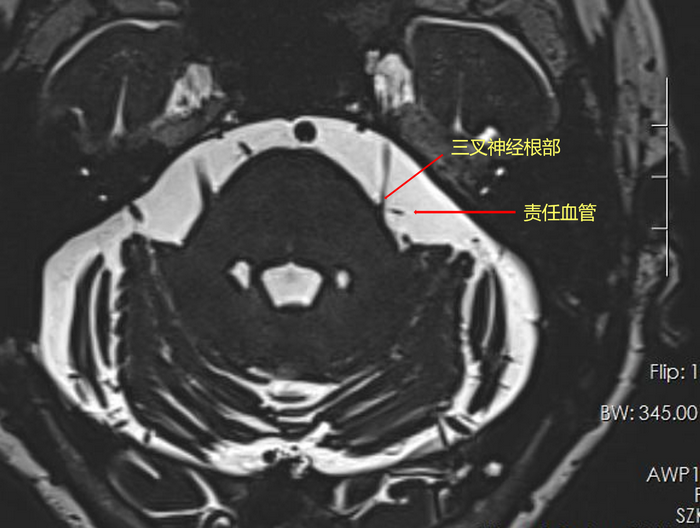 六旬患者饱受三叉神经痛折磨 微血管减压术“一招止痛”_1.png