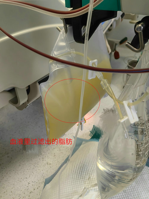 偏好高油、高脂食物 年轻女子突发重症急性胰腺炎_1.jpg