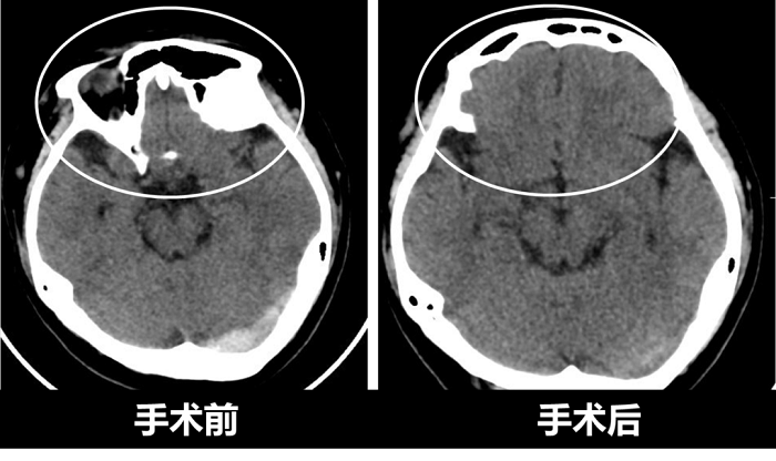 我院开展多例颅内静脉窦取栓，专家提醒年轻人警惕头疼症状.png
