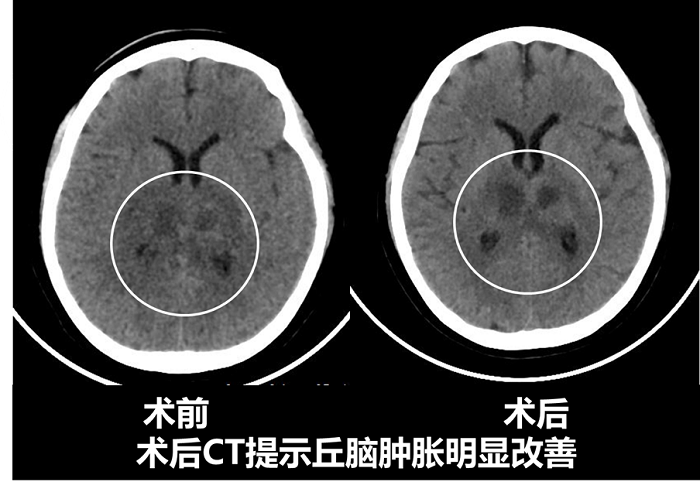 我院开展多例颅内静脉窦取栓，专家提醒年轻人警惕头疼症状2.png