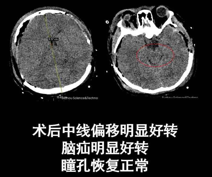 花季少女突遭车祸深度昏迷，多学科协作上演“生死时速2.jpg