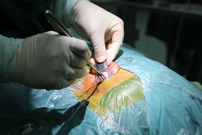 江苏省首例 我院完成梅尼埃病半规管阻塞同期人工耳蜗植入2.jpg 江苏省首例 我院完成梅尼埃病半规管阻塞同期人工耳蜗植入2.jpg