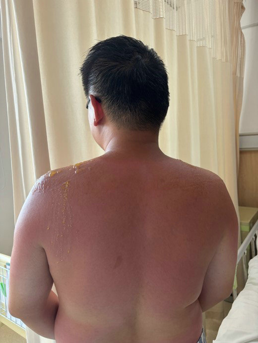 男子海边游玩大面积晒伤专家提醒警惕“紫外线陷阱”.jpg