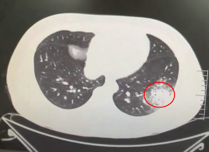 儿童胸痛一月，竟是衣原体肺炎.jpg
