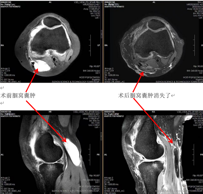 膝关节长包原是“腘窝囊肿”  南大苏州医院微创手术创伤小恢复快.png