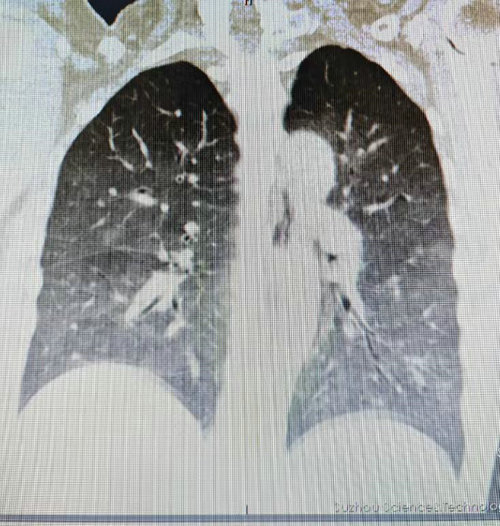 女子反复高热拖成“白肺” 专家建议千万不能拖.jpg 女子反复高热拖成“白肺” 专家建议千万不能拖.jpg