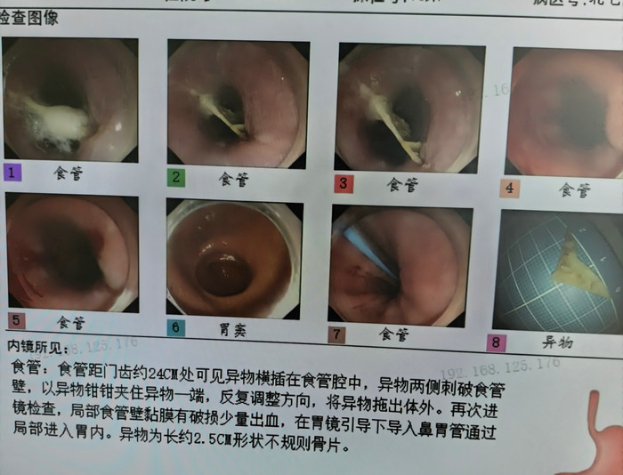 骨头紧贴主动脉弓 我院多学科深夜会诊排险