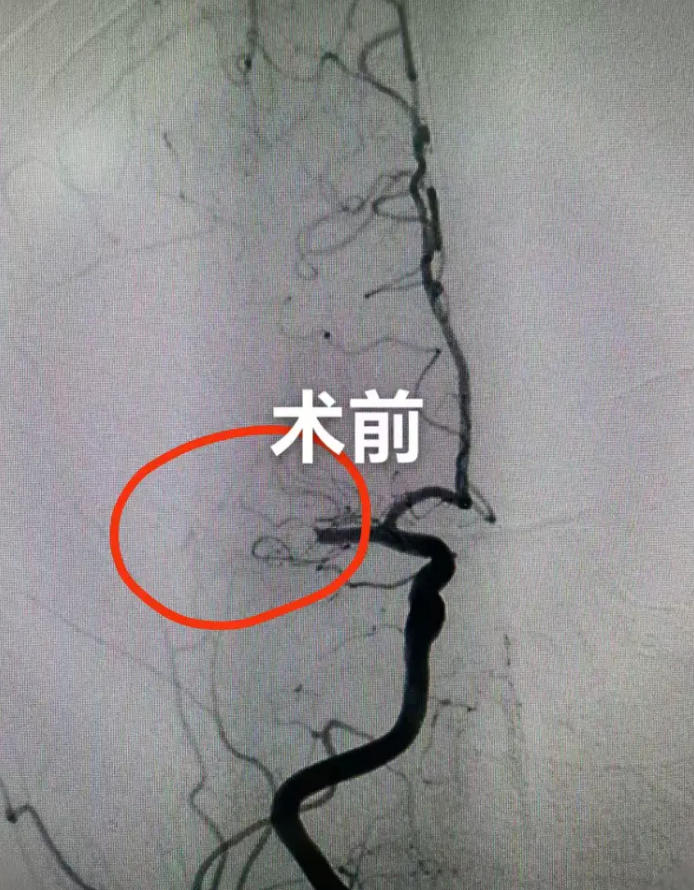 金庭患者突发脑梗 南大苏州医院跑出“加速度”.jpg 金庭患者突发脑梗 南大苏州医院跑出“加速度”.jpg