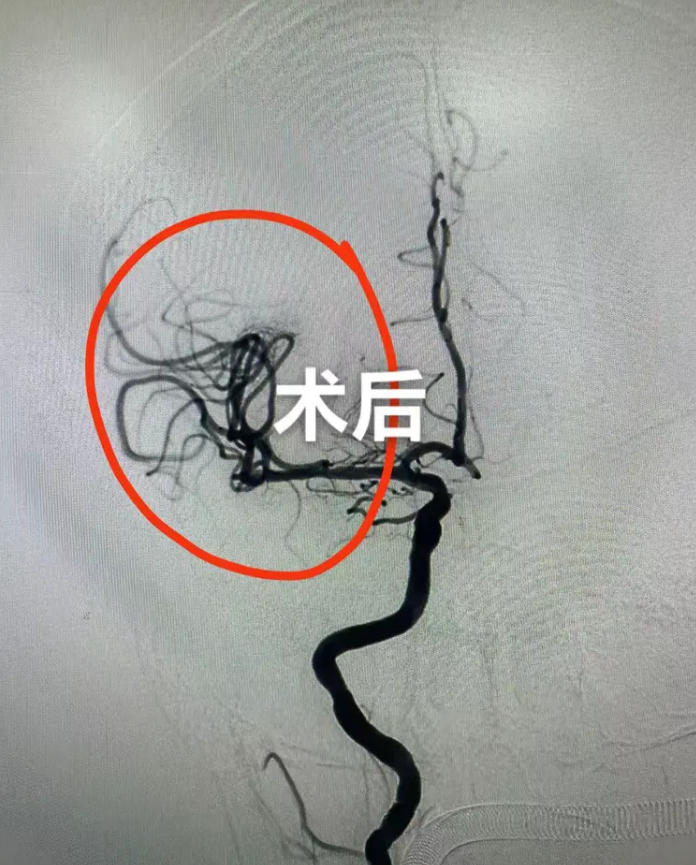 金庭患者突发脑梗 南大苏州医院跑出“加速度”2.jpg 金庭患者突发脑梗 南大苏州医院跑出“加速度”2.jpg