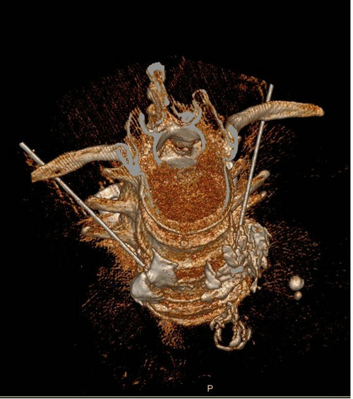 糖尿病人双脚似蚁爬 我院微创手术解烦忧2.jpg