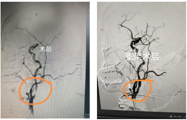 打通脑部生命线  南大苏州医院一站式解决复杂多发脑血管狭窄.jpg