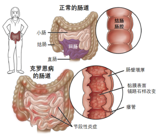 克罗恩病与胆囊结石双重夹击 我院多学科合作助力患者重获新生.png