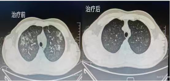 18岁青年肺部疑难感染久治不愈 我院精准破解“双重病变”难题.jpg 18岁青年肺部疑难感染久治不愈 我院精准破解“双重病变”难题.jpg